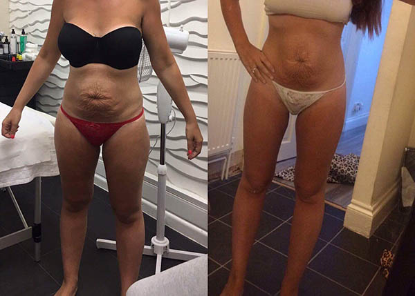 Laser Lipo 8