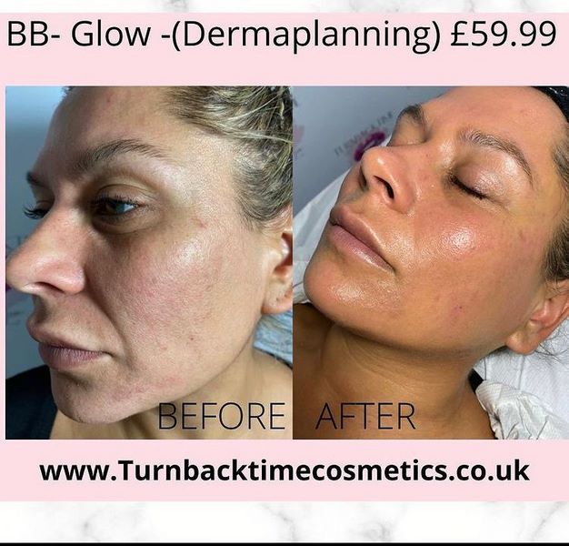 BB glow dermaplanning